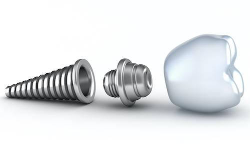 dental implant screw model