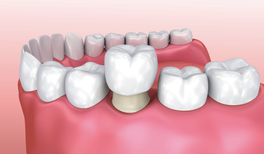 dental crown illustration