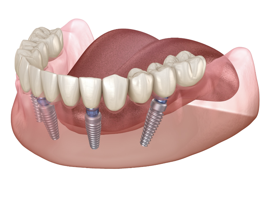dental implant supported dentures