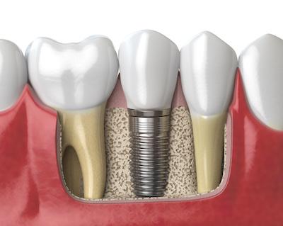 dental implant sideview