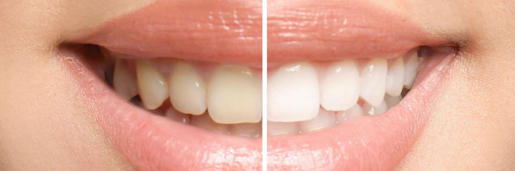 before and after teeth whitening result in Knoxville, TN