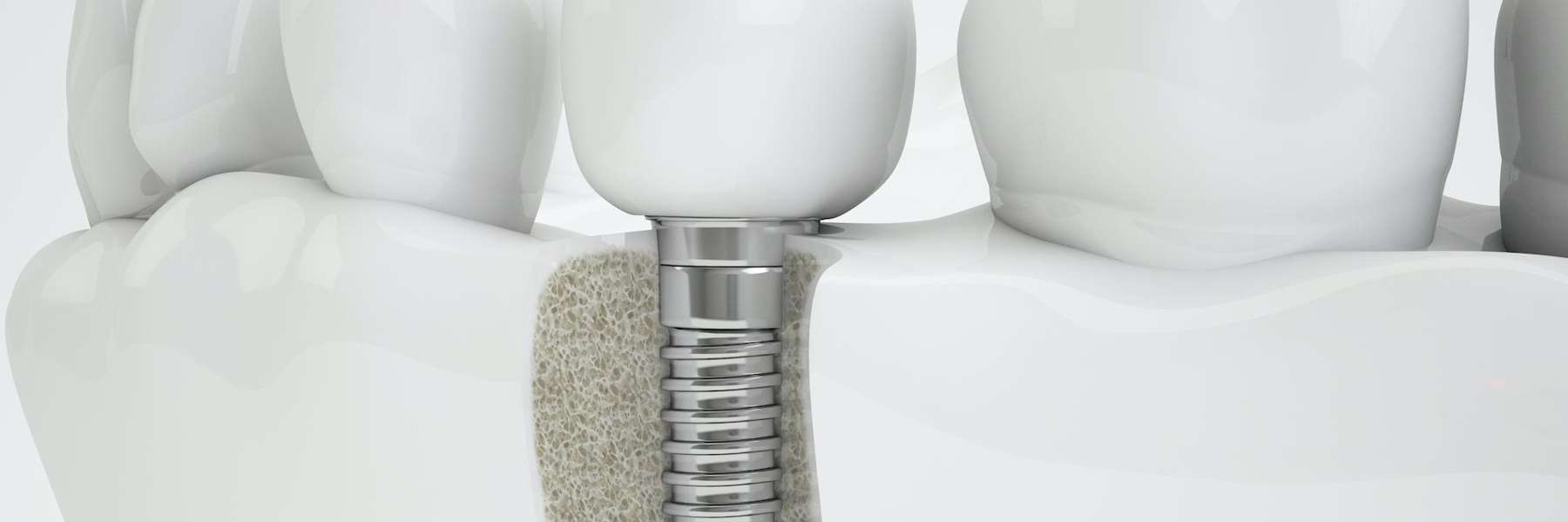 dental implant image with screw