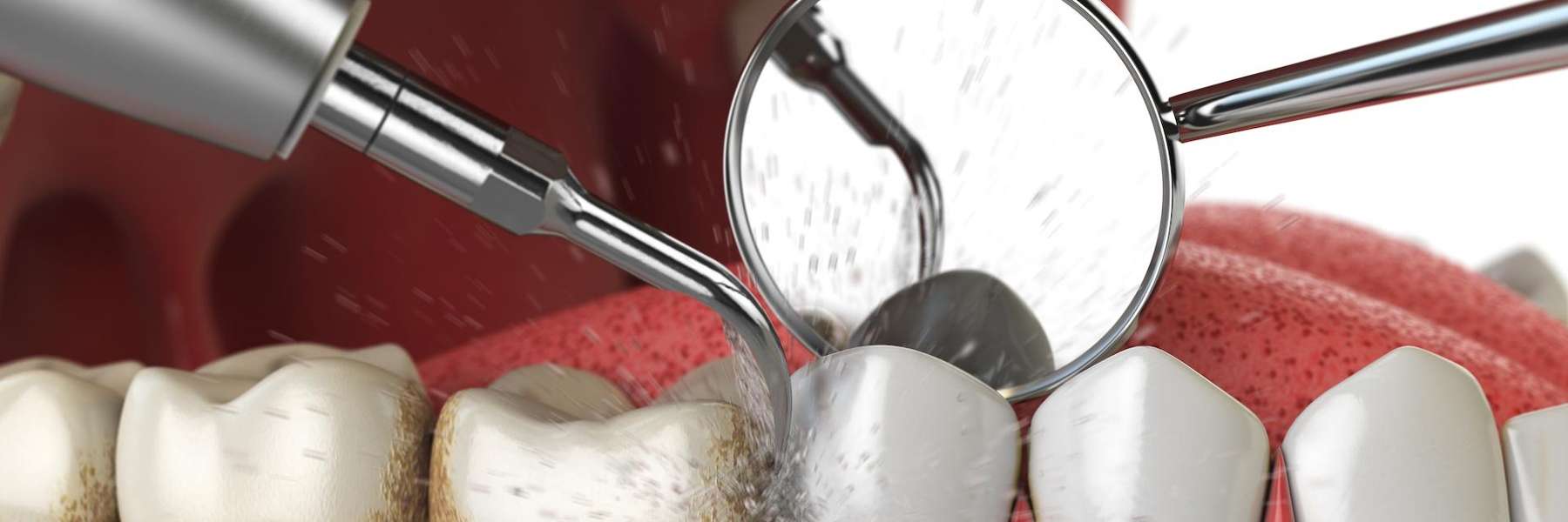 dental cleaning knoxville TN