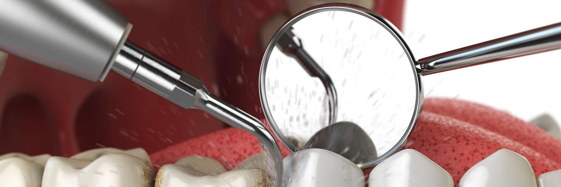 dental cleaning in knoxville tn