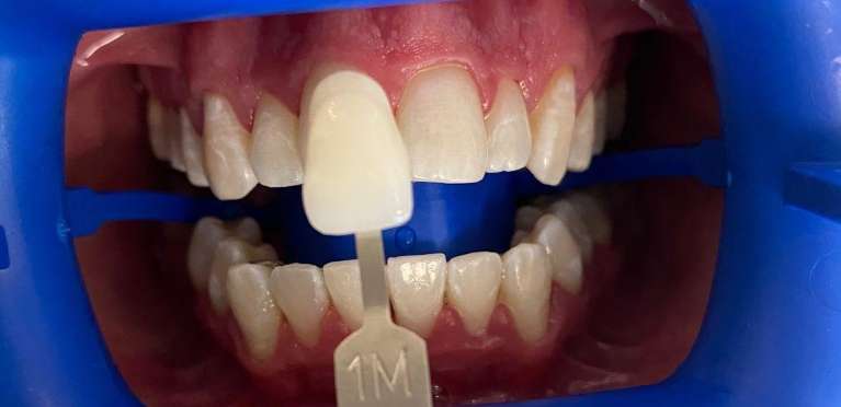 Professional-Teeth-Whitening-After-Image