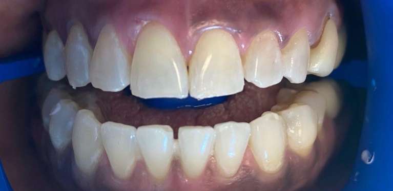Professional-Teeth-Whitening-After-Image