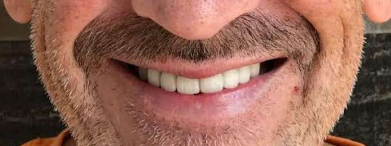 Dental-Crowns-and-Bridge-After-Image