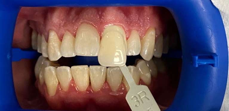 Professional-Teeth-Whitening-Before-Image