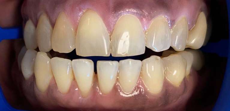 Professional-Teeth-Whitening-Before-Image