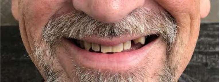 Dental-Crowns-and-Bridge-Before-Image
